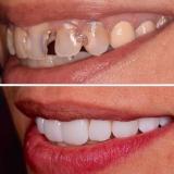 Dental HD (Tratamientos de Belleza)